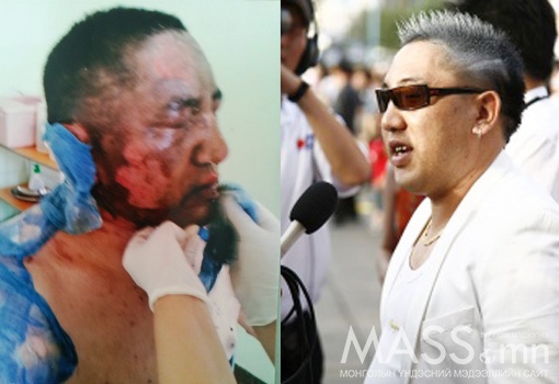 Баавар Солонгост арьс солиулах хагалгаанд орно